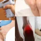 Şok Dalga (ESWT) Tedavisi Nedir?